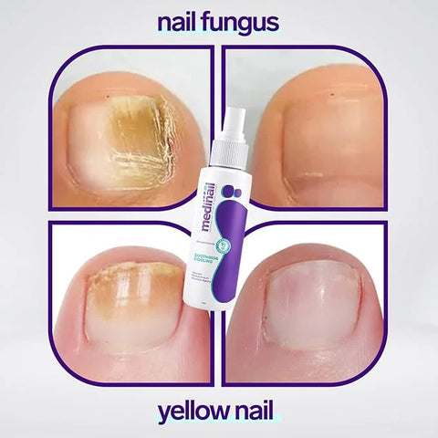Jaysuing Nail Fungus Treatment Spray